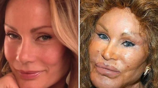 Jocelyn Wildenstein  - Las 16 peores cirugías de famosos WTF!