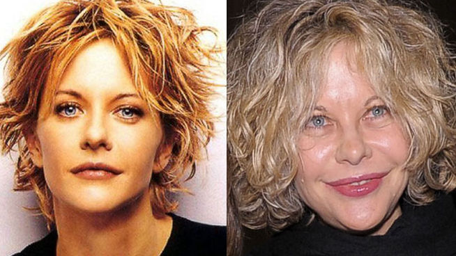 Meg Ryan  - Las 16 peores cirugías de famosos WTF!