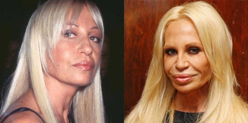 donatella versace 1 - Las 16 peores cirugías de famosos WTF!