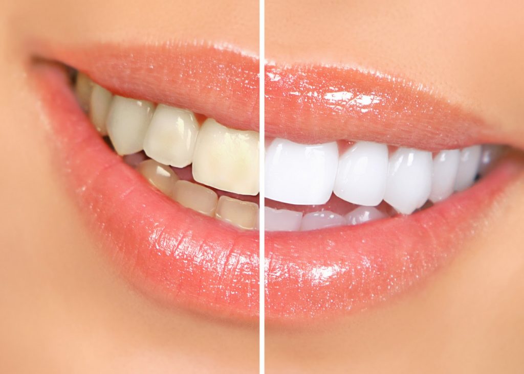 blanqueamiento dental Vegan Smiles Teeth Whitening  1024x732 - BLANQUEAMIENTO DENTAL QUE USAN LAS CELEBRITIES #Miami